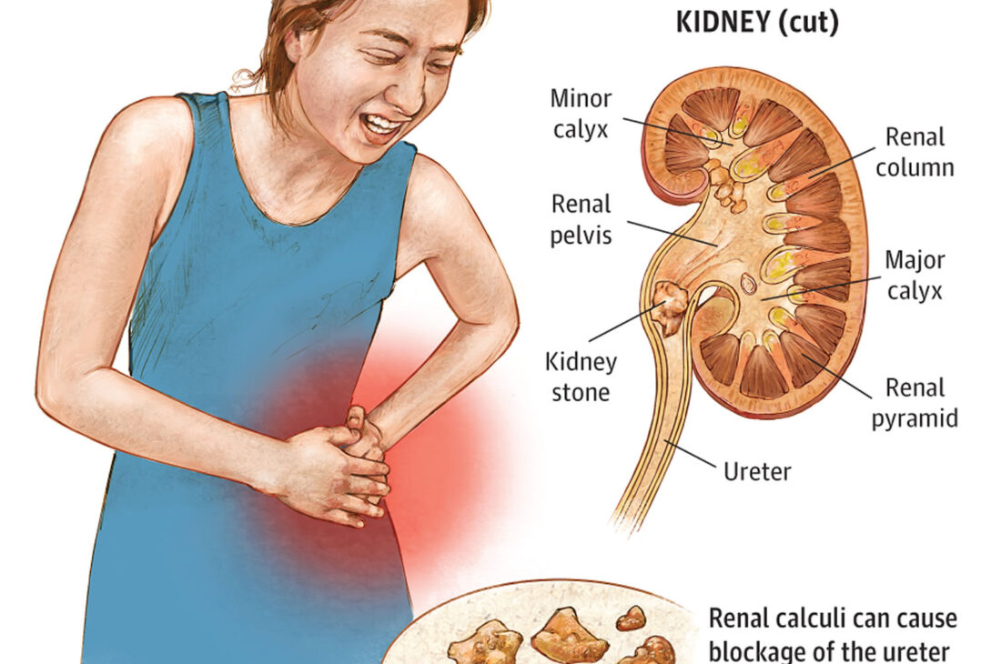 Uric Acid and Kidney Stones